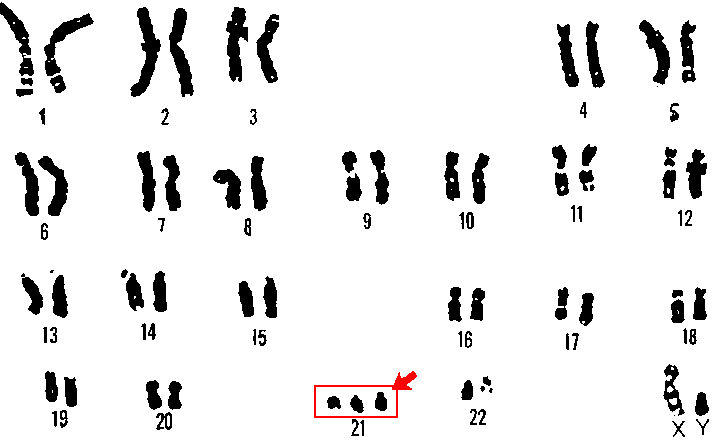 Image result for Down Syndrome Chromosome 21